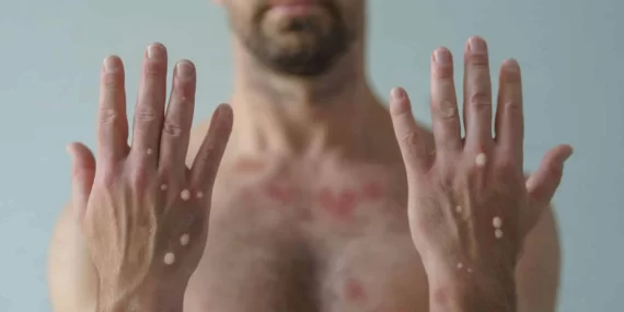 Maymun-cicegi-virusu-9795687690